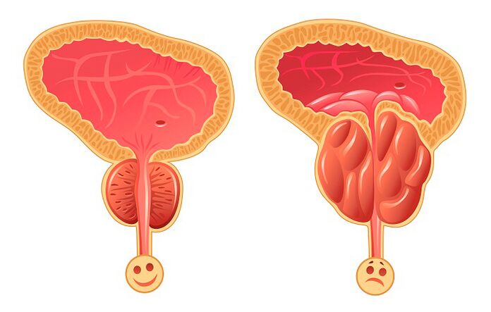 Normalna i zapalna prostata