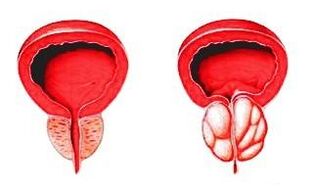 Prostata w stanie normalnym (po lewej) i ze stanem zapalnym prostaty (po prawej)