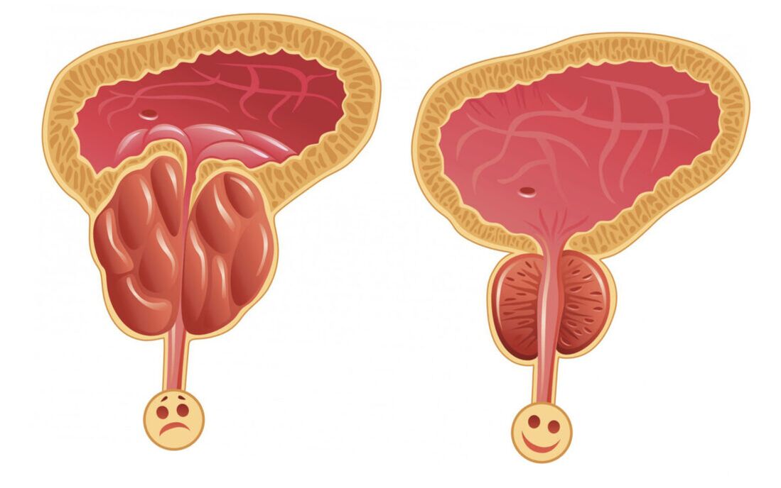Zapalenie prostaty z zapaleniem gruczołu krokowego (po lewej) i gruczoł krokowy w normie (po prawej)